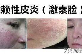 怎样回应成激素脸？激素脸如何预防以及修复？图片