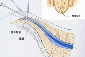 做痔疮手术后腿动不了了，扑朔迷离的背后竟然是一根电线惹的祸图片