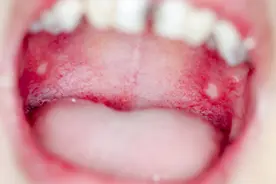 有一种苦，是口腔溃疡，维生素治不好，可以用这些办法治疗图片
