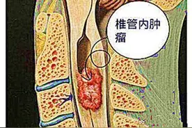 37岁女子手麻，以为是颈椎病，医院检查：颈椎里有个鸡蛋大的肿瘤图片