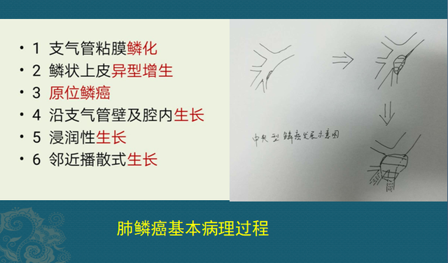 肺癌病理非角化型鳞癌