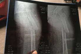 医院扶手脱落老人大腿骨摔成两截！躺俩月院方却一直拖着不给做手术图片