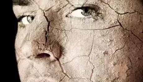 鱼鳞病流汗吗 鱼鳞病流汗吗