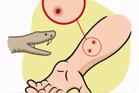 浙江男子走夜路被剧毒蛇咬，成功自救！做法实用，比教科书还经典图片