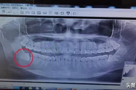 话题讨论：拔牙拔一半又缝上，牙医让再长长…图片