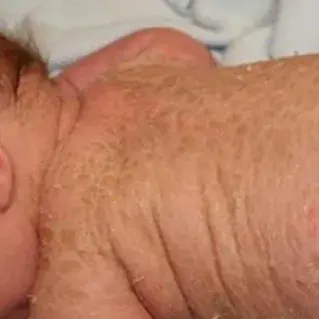 鱼鳞病发病年龄