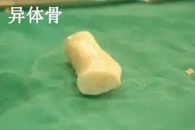 用男朋友的肋软骨隆鼻行不行？异体骨鼻整形靠谱吗？图片