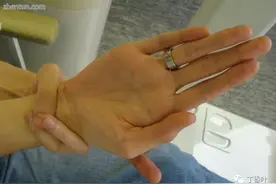 马凡综合征图片