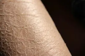 小腿为何如鱼鳞、蛇皮？医生：皮肤反映身体内部，可能有5点原因图片