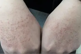 当心！23岁小伙一天洗手十多次，洗出密密麻麻小红斑图片