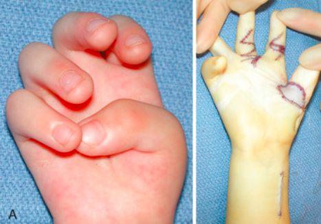 一个多月的宝宝握拳头大拇指在内是脑瘫吗(一个半月宝宝大拇指内握)