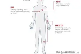 下肢静脉血栓的两三事儿图片