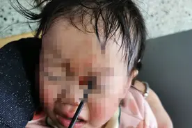 可怕！筷子粗的塑料杆戳进女童眼睛直插颅脑！图片