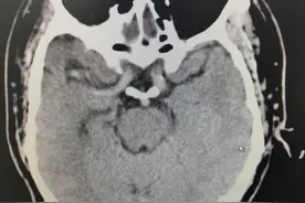 43岁男性血压＞200mmHg，都脑梗了，竟然还不吃降压药图片