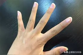 手指关节疼痛、僵硬，是怎么回事？是类风湿吗？图片