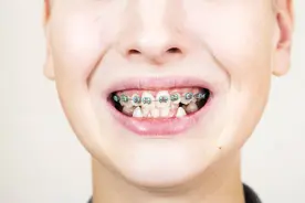 牙齿正畸血泪史：牙套让我脸变形，牙齿矫正要趁早图片