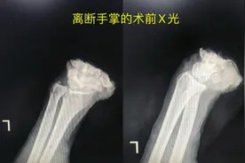 痛！一饭堂厨师砍猪脚时竟砍断了自己的手图片