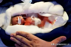 全球最小“苹果婴儿”，比手掌还小，6个月过去了，现状如何？图片