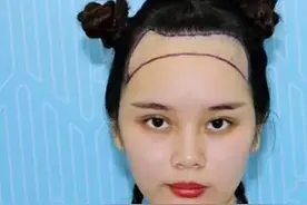是什么让我告别脱发，摆脱大额头？图片