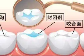 幼童牙齿涂氟真的能预防龋齿吗？会对身体有害吗？听听牙医的说法图片