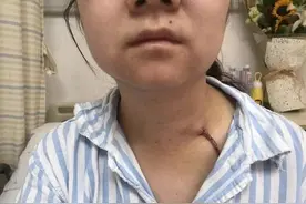 甲状腺癌是怎么引起的呢？3个原因是“祸根”，5个方面需要加强图片