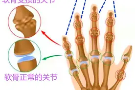 50岁左右的中老年人，手指僵硬、疼痛、怕冷、变形，预示哪些疾病图片