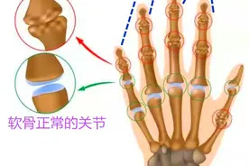 50岁左右的中老年人，手指僵硬、疼痛、怕冷、变形，预示哪些疾病图片