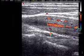 福州女子患上“东方美女病”，美丽的名字下，藏着凶险的病情图片