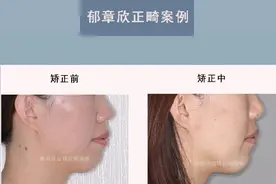 青岛牙齿矫正：「双颌前突，下颌后缩」舌侧隐形矫正中案例图片