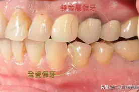 全瓷牙和烤瓷牙的区别？该怎么选？良心牙医却这样说图片