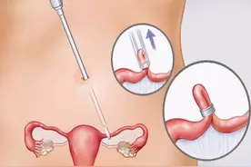 女生结扎后，排出的卵子去哪了？看完或许更明白图片