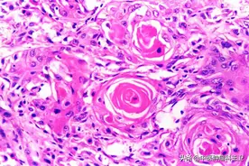 夺走很多人生命的鳞状细胞癌，没听过不要紧，症状你一定不陌生图片