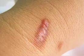 疤痕也会癌变！身上有疤的人注意，做好 5 件事图片