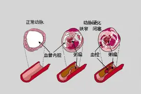 好消息!心脑血管患者注意，“百元心脏支架”已落地合肥图片