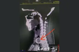大理一女子喉咙疼！医生：食道里有啤酒瓶盖图片