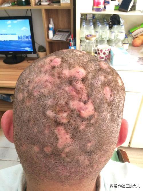 疔疮,青春痘愈后的色素沉着面部的疔疮,青春痘面部的疔疮头发中的疔疮