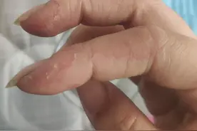 困扰多年的皮肤问题图片