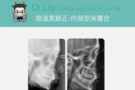 厦门牙齿矫正：「隐适美矫正-内倾型深覆合案例」图片