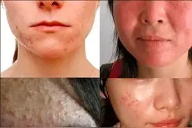 要想根源除去螨虫危害，要做到深度除螨才有效图片