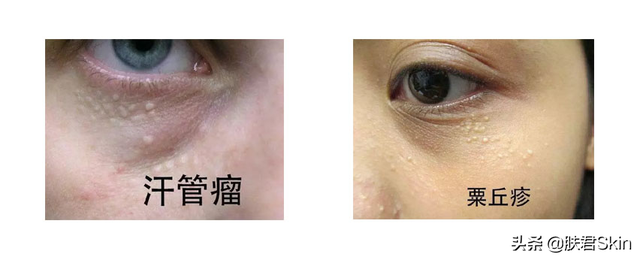 栗丘疹和汗管瘤的区别图片
