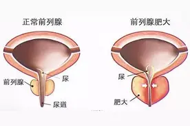 前列腺有问题，同时血压高，选哪个药？还能改善性功能？图片