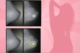 乳腺钼靶检查图片