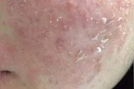 如何修复激素脸图片