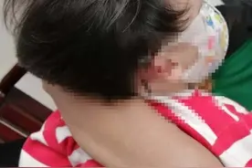 7厘米长的螺丝刀插入2岁女孩脑部，只因一个小疏忽图片