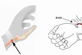 女性50岁之后，极易遭受腱鞘炎的折磨，为什么？如何治疗？图片