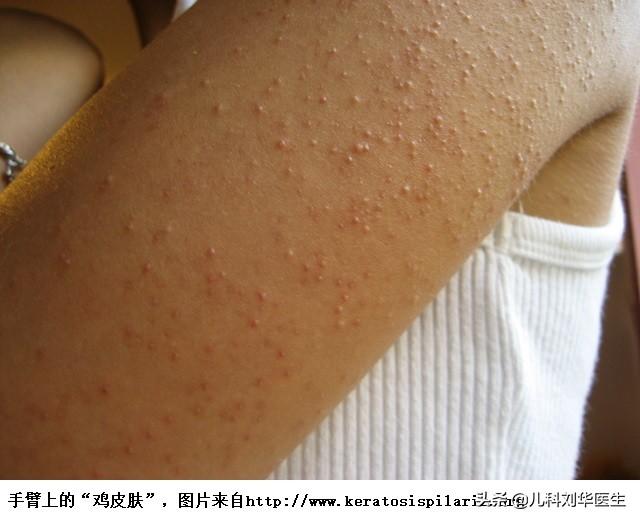 痒鸡皮疙瘩粗糙