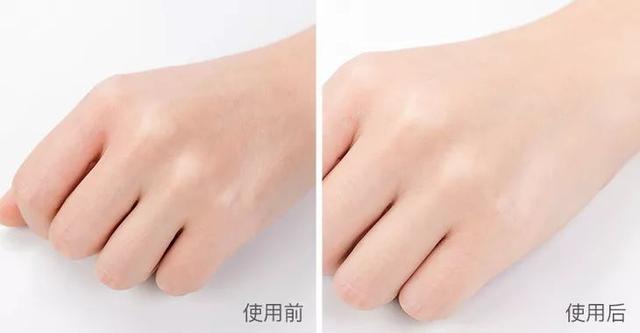 去粉刺毛囊炎痤疮鸡皮身体乳