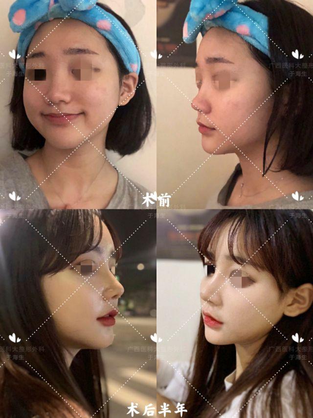 鼻子整形有哪些类型,2021最火鼻型|手术方式 - 冷求网