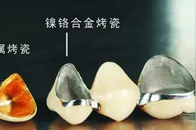 牙科医生讲义第十三讲：什么是烤瓷熔附金属全冠图片