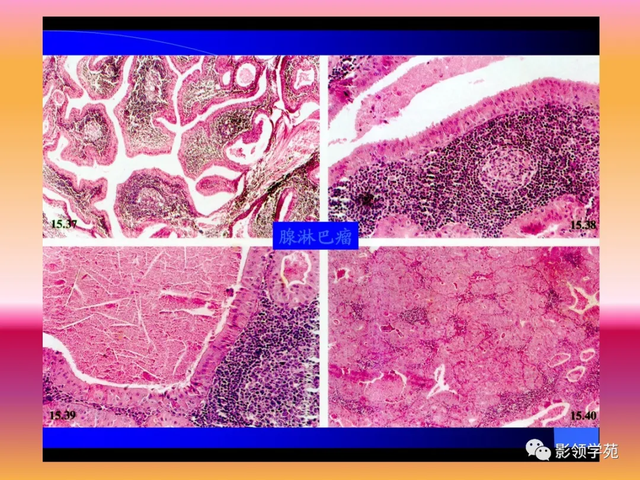 腮腺角化型鳞癌
